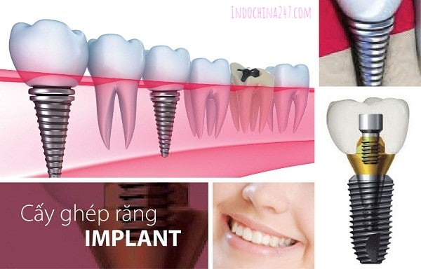Nhận đặt hàng và vận chuyển implant từ Mỹ về Việt Nam