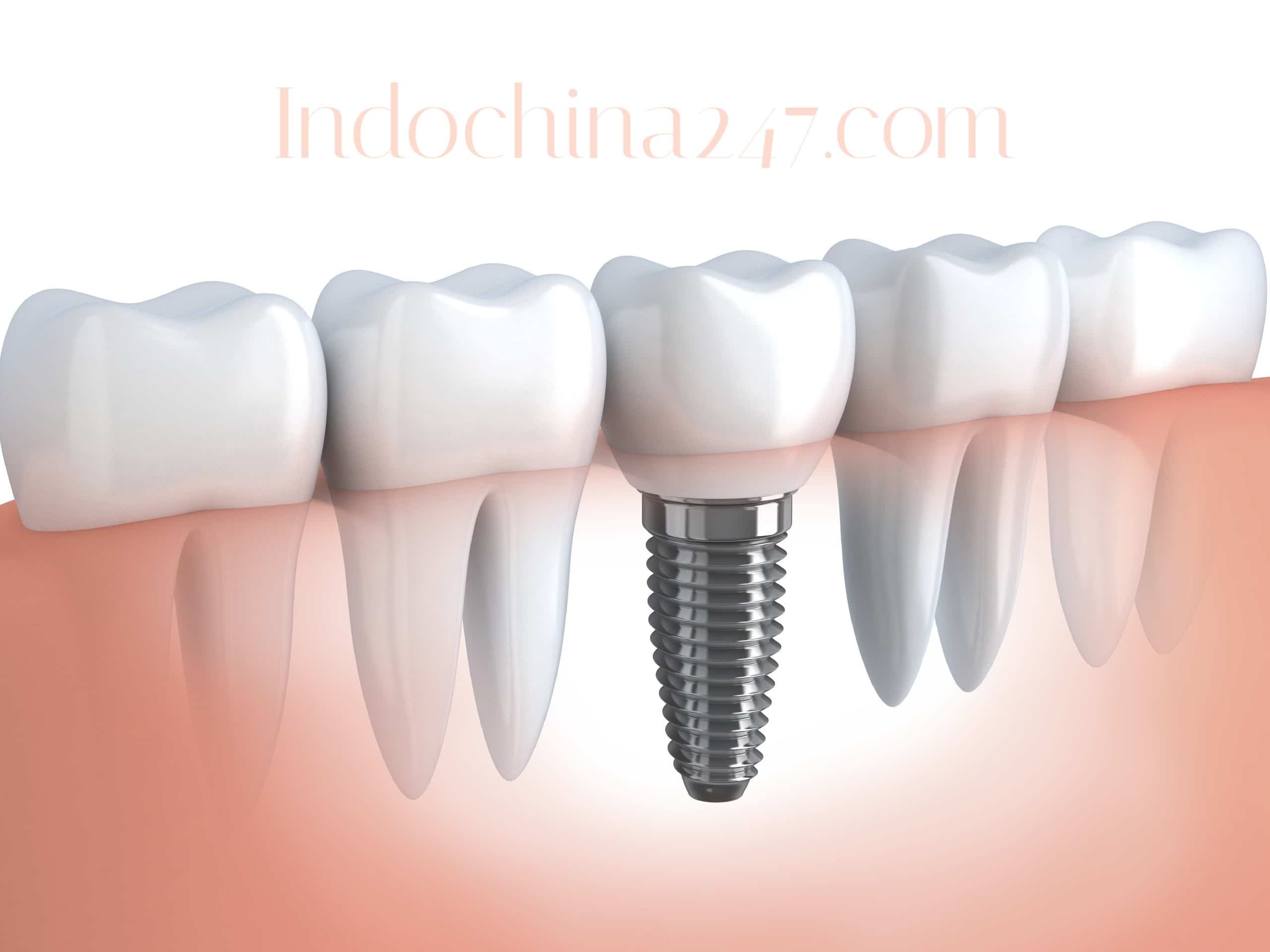 Nhận đặt hàng và vận chuyển implant từ Mỹ về Việt Nam