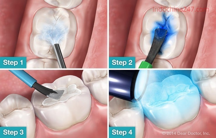 Vận chuyển hàng xách tay là vật liệu nha khoa từ Mỹ