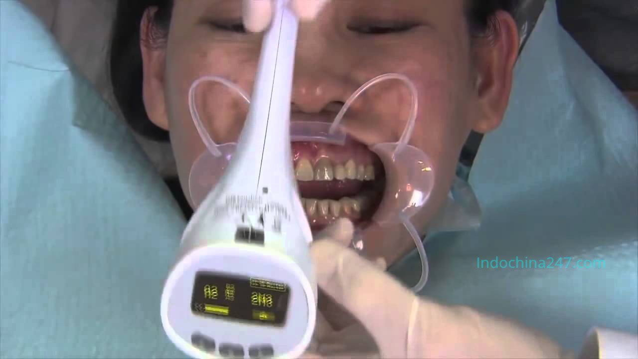 Vận chuyển hàng xách tay là vật liệu nha khoa từ Mỹ